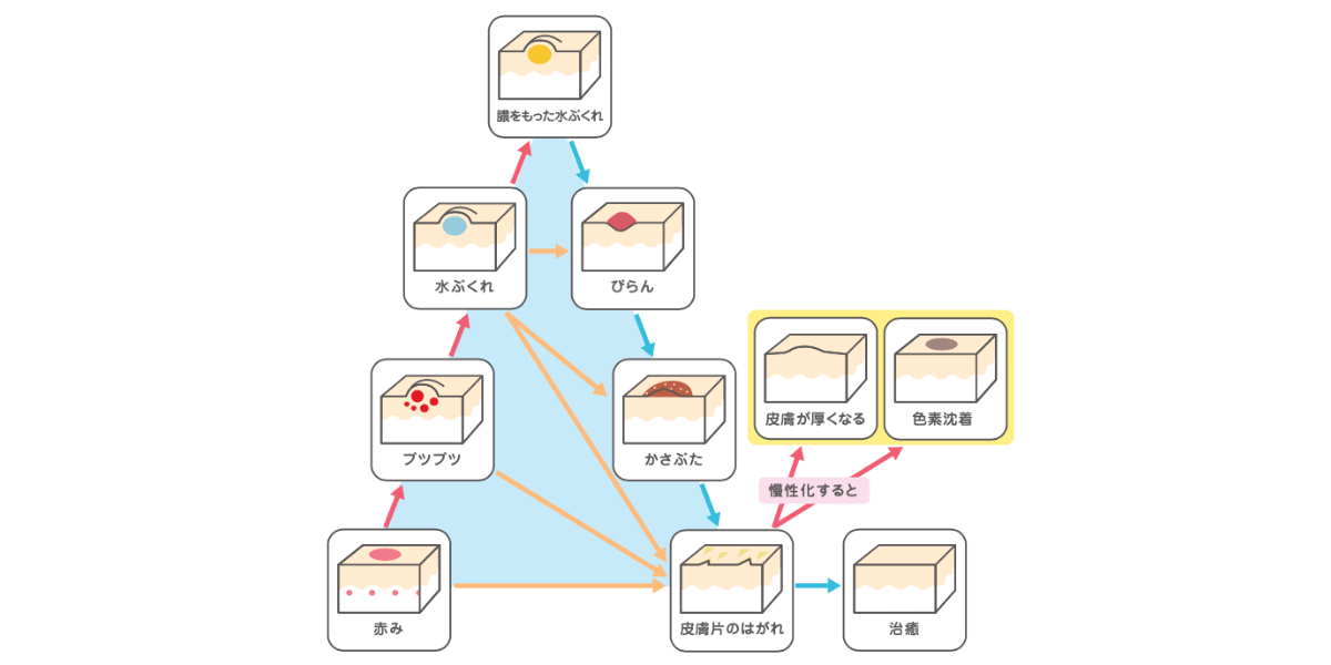 湿疹の症状