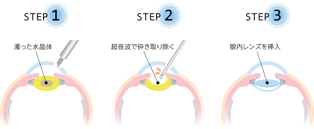 白内障の治療法