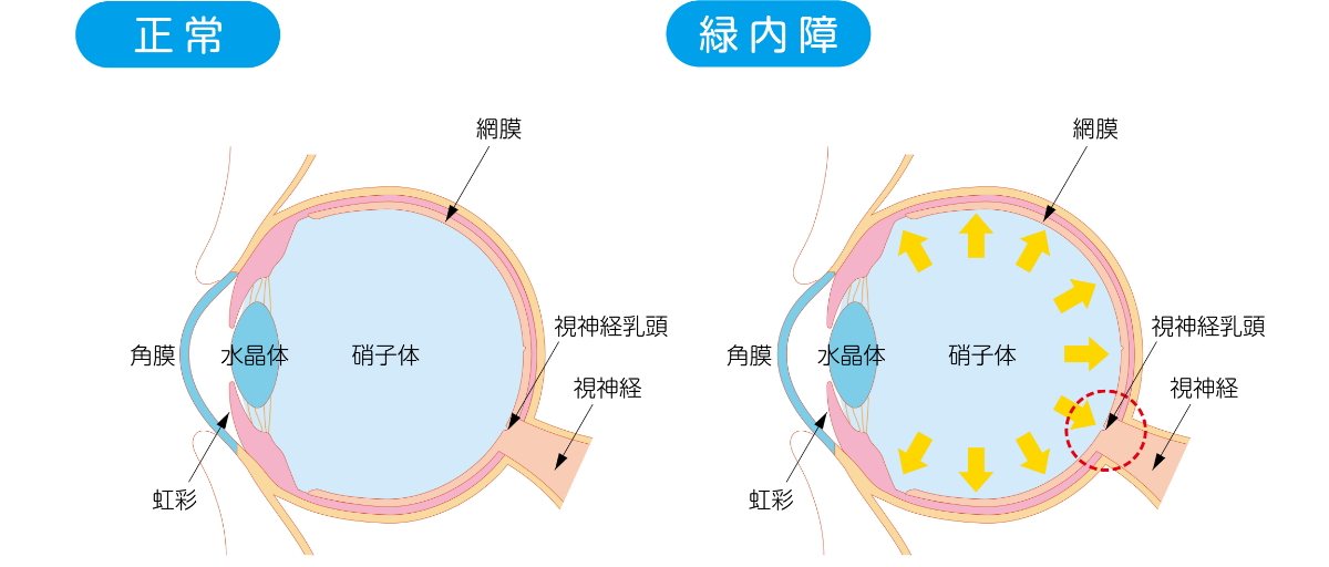 緑内障の原因2