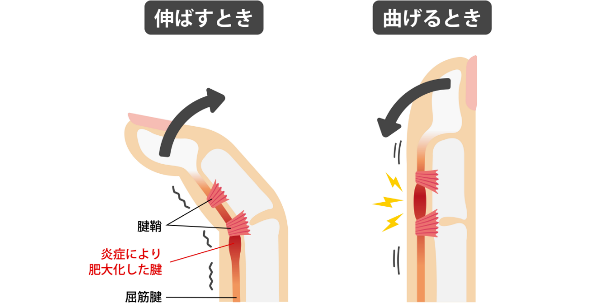 ドケルバン病（狭窄性腱鞘炎）